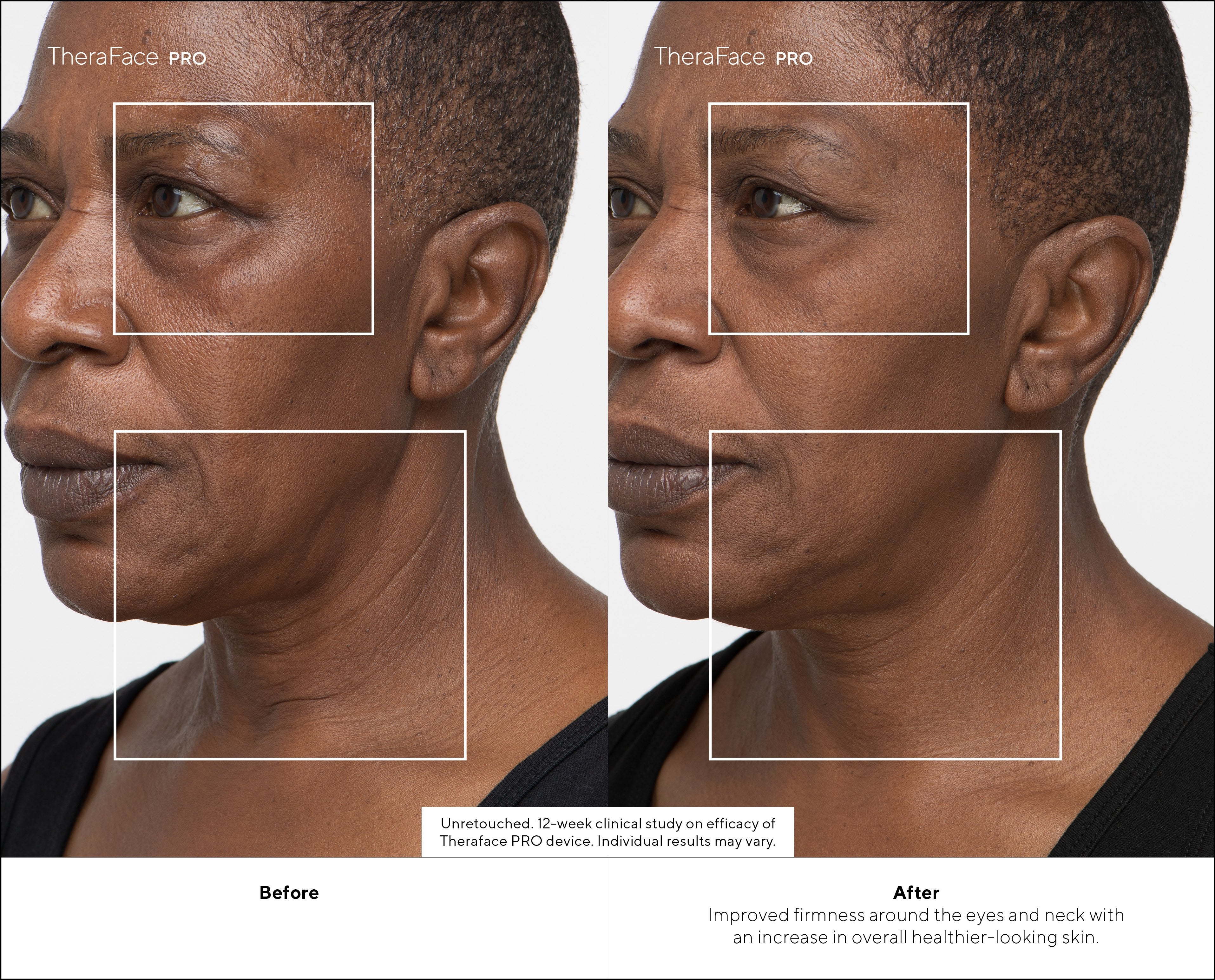 Masajeador Therabody Theraface Pro Cara Negro