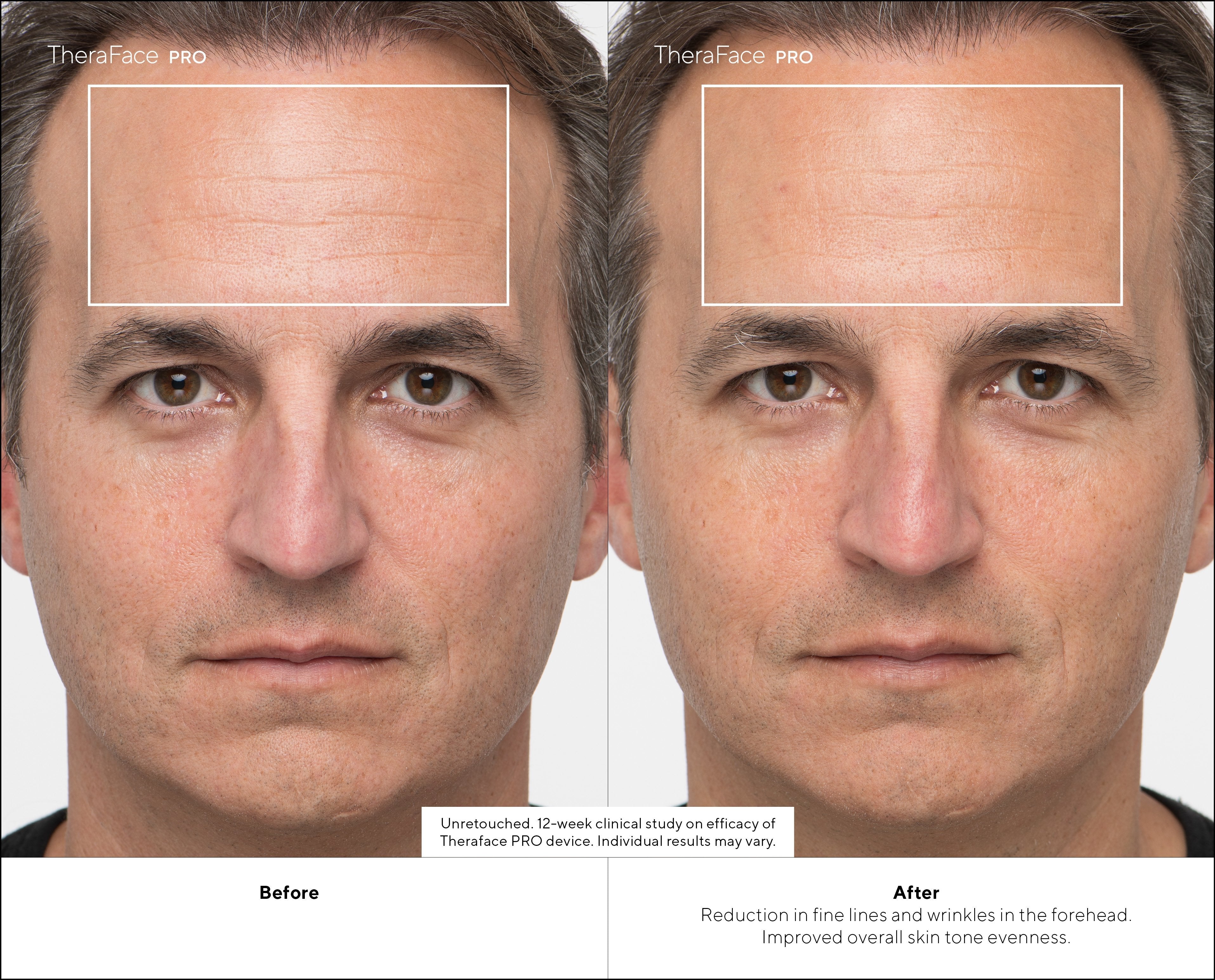 Masajeador Therabody Theraface Pro Cara Negro