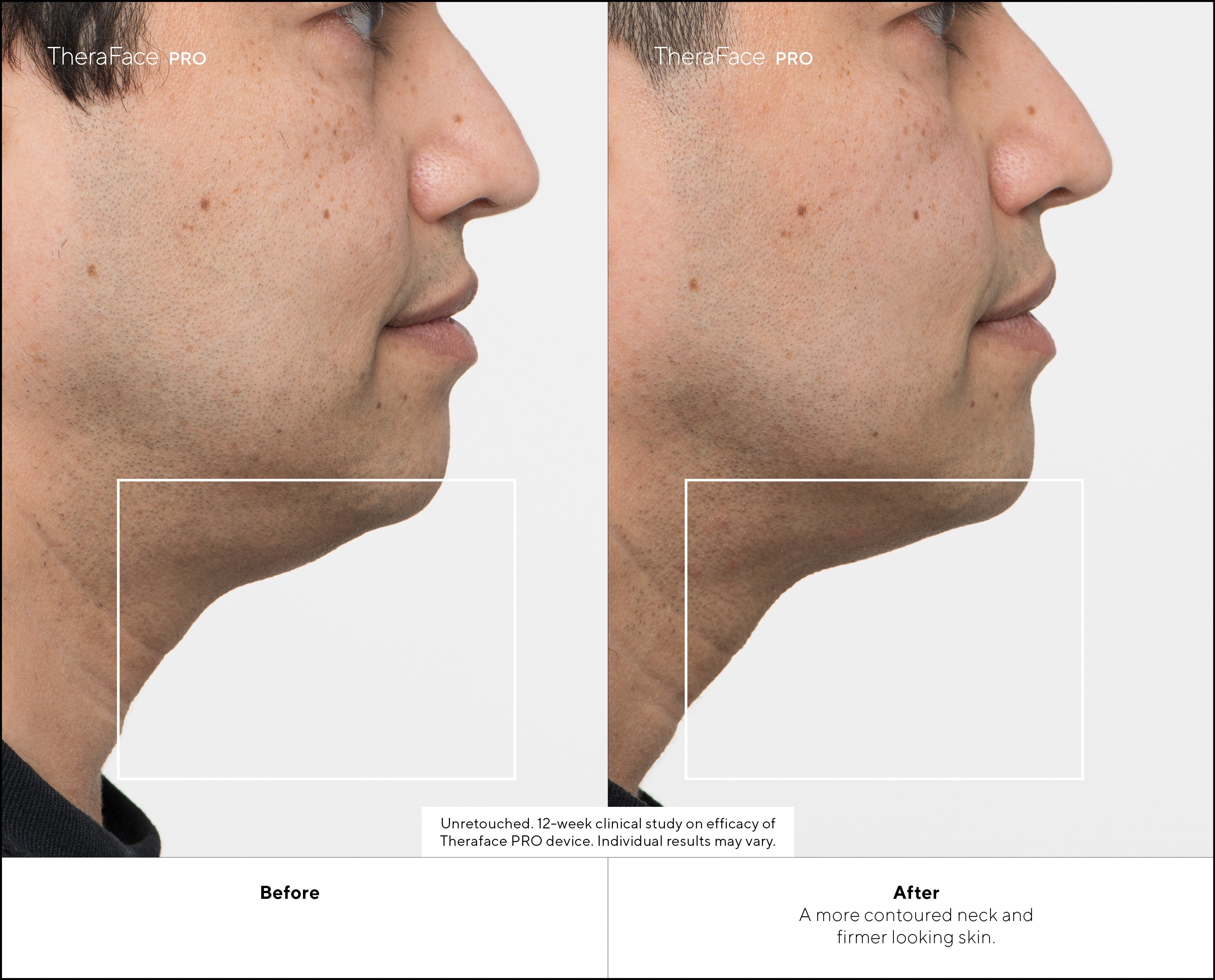 Masajeador Therabody Theraface Pro Cara Negro